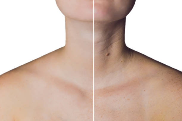 How to Get Rid of Neck Lines, According to a Dermatologist?