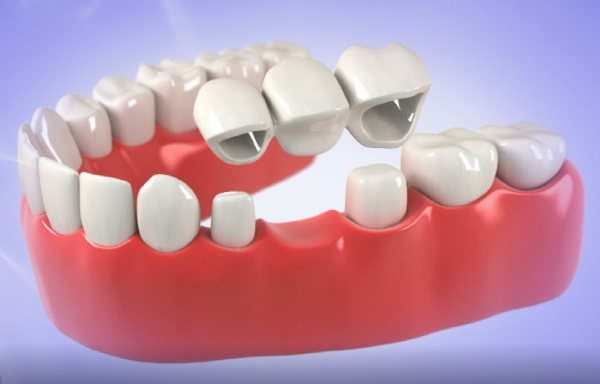 How Much Does A Dental Bridge Cost With Insurance?