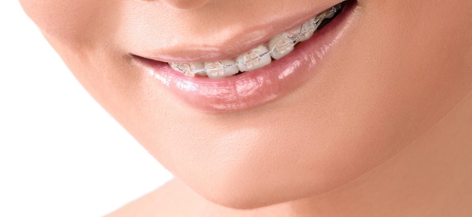 How Much Do Invisible Braces Cost?