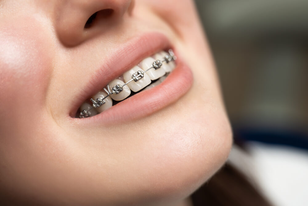 Are You Thinking About Choosing Invisible Braces?