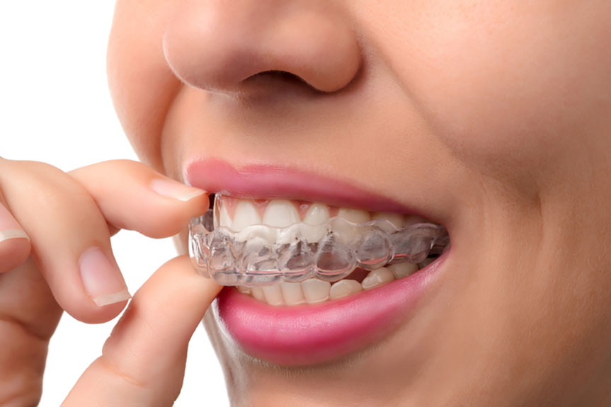 Getting Back Your Smile with Invisible Braces